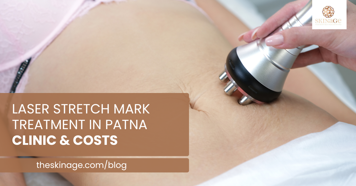 Laser Stretch Mark Treatment in Patna – Clinics & Costs
