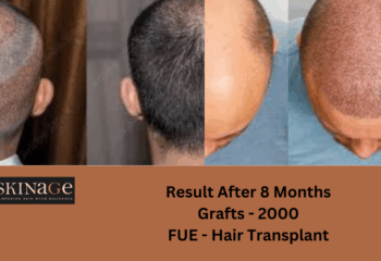Hair Transplant in Patna: Cost, Procedures & Best Clinics