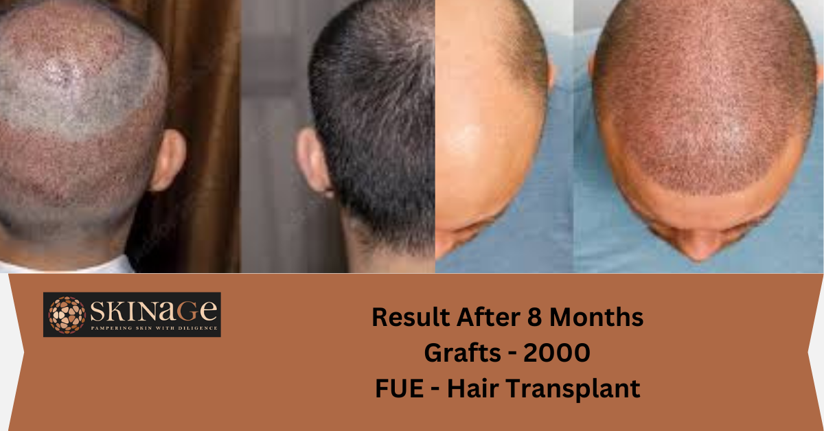 Hair Transplant in Patna: Cost, Procedures & Best Clinics