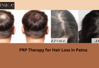 PRP Therapy for Hair Loss in Patna: A Comprehensive Overview